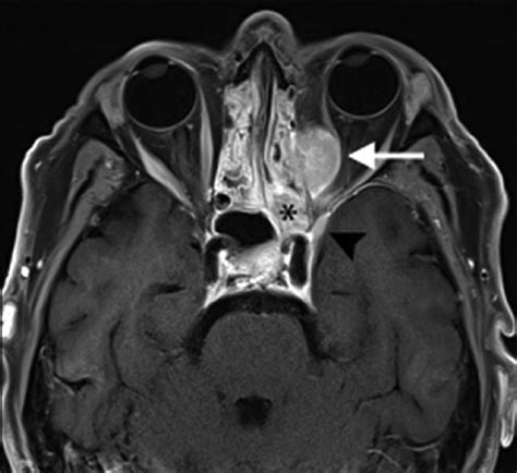 Axial Contrast Enhanced T1 Weighted Magnetic Resonance Image Orbital