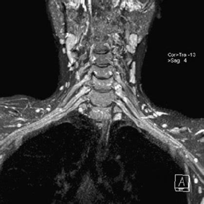 Cervical Nerve Root Anatomy