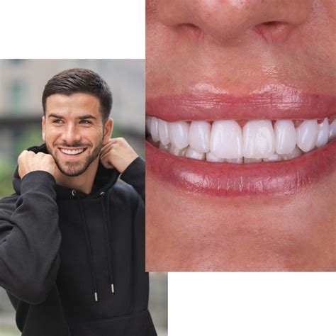 Carillas Dentales En Valencia Sof A Cort S Cl Nica Dental