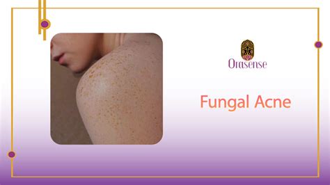 Fungal Acne: Understanding Its Causes and Solutions