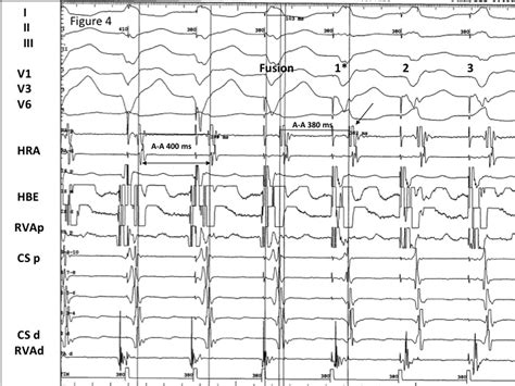 His Overdrive Pacing During Supraventricular Tachycardia A Novel Maneuver For Distinguishing