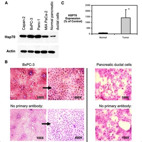 Hsp Levels In Pancreatic Cancer Cells A Pancreatic Adenocarcinoma