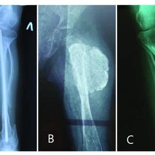 X-ray of patients 8 (A), 11 (B) and 12 (C). We see the absence of ...