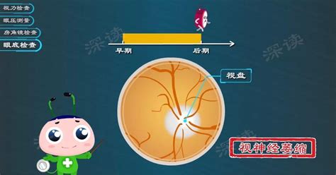 最新消息看眼底就能查青光眼动漫科普青光眼检查黑科技 知乎