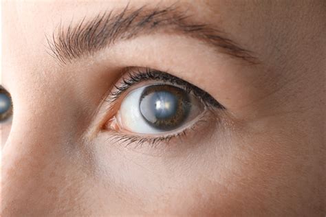 What Are The 3 Types Of Cataracts Symptoms And Treatment