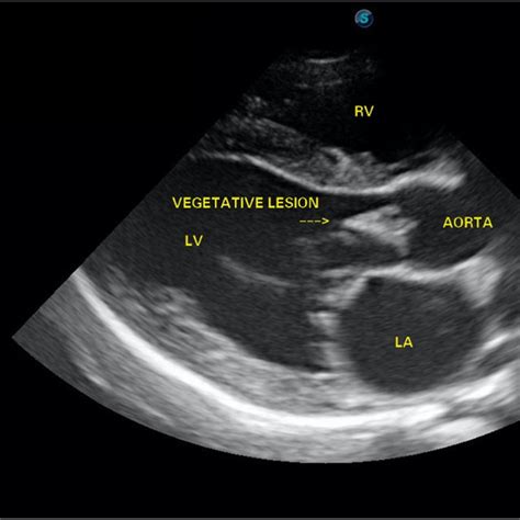 Aortic valve vegetation as seen on right parasternal long axis ...