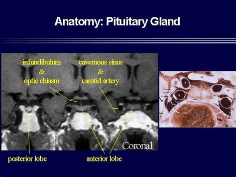 Pituitary Anatomy Mri