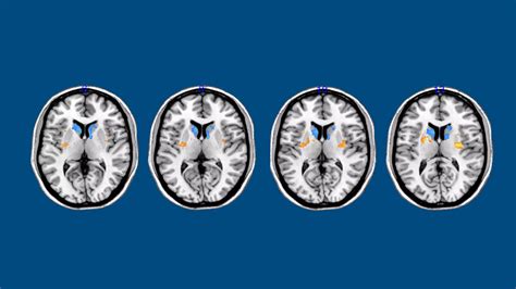 Neue Hoffnung für Parkinson Patienten durch Stammzelltechnologie