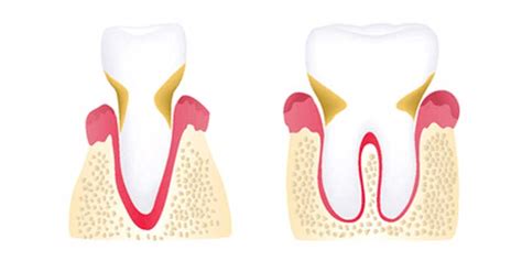 Stages Of Periodontal Disease Tmj Plus Wellness Center