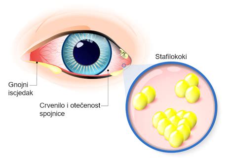 Konjuktivitis Simptomi Liječenje Slike I Video