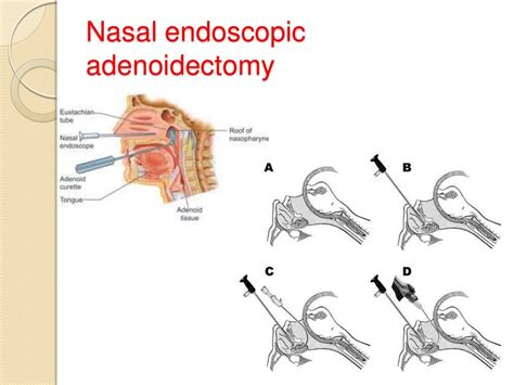 Adenoidsandadenoidectomy By Roohia