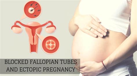 Blocked Fallopian Tubes Causes Symptoms And Fertility