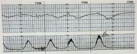 Intrapartum Fetal Surveillance Flashcards Quizlet