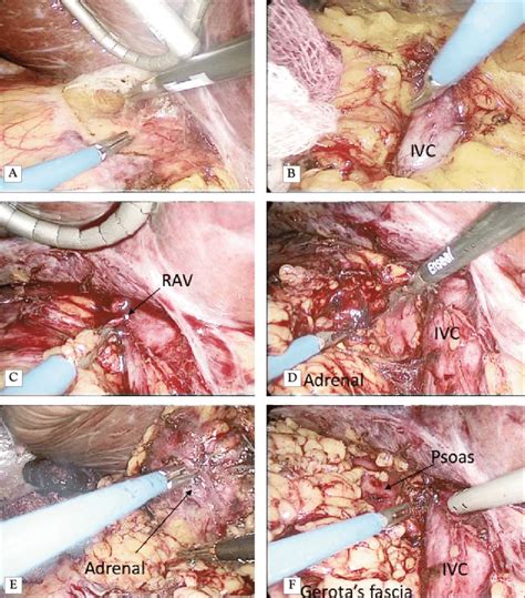 Steps Of A Right Lateral Transabdominal Laparoscopic Adrenalectomy A