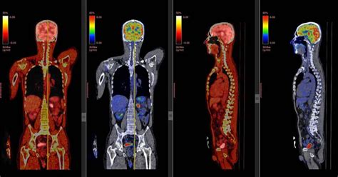 What Is A PET Scan And What Is It Used For? - Health365.sg