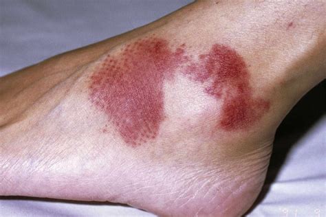 Aplastic Anemia Rash Types Treatment And More