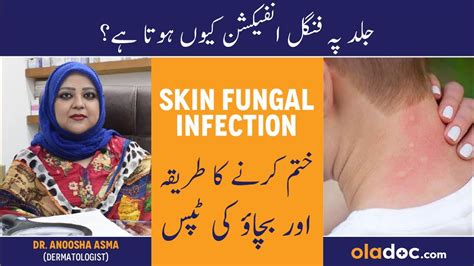 Skin Fungal Infection Treatment In Urdu Hindi Dad Khad Ka Ilaj Skin