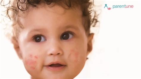 Baby Acne Causes Prevention Tips