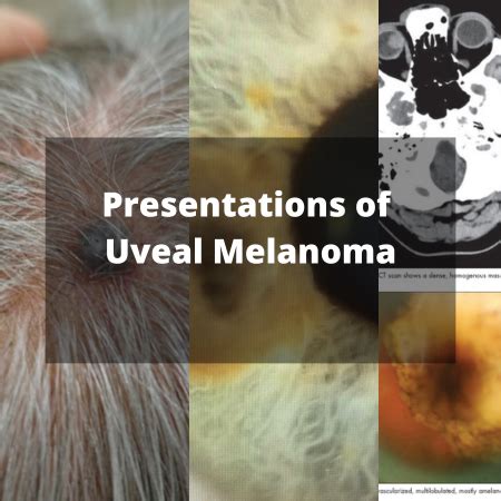 Presentations Of Uveal Melanoma