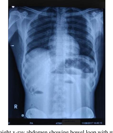 Figure 1 From Rare Case Of Acute Strangulated Intestinal Obstruction