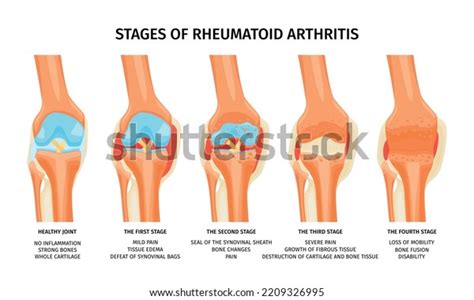 607 Rheumatoid Arthritis Body Diagram Images, Stock Photos & Vectors ...