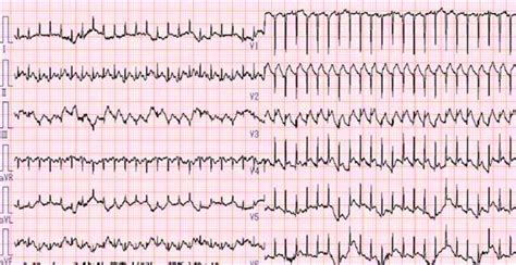 Electrocardiography On Admission Showing Sinus Tachycardia 140