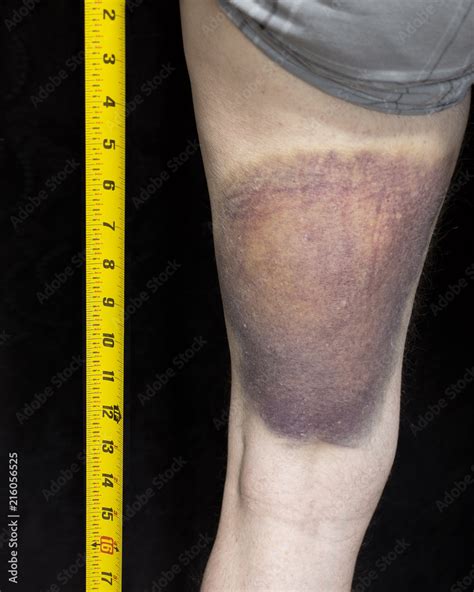 Pulled Hamstring Bruise