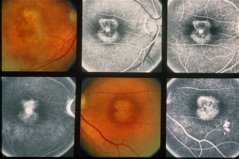 Cone Dystrophy - Retina Image Bank