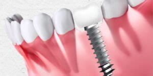 Basal Dental Implants - Simpladent Clinics