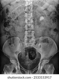 kub  ray imaging  images  pictures