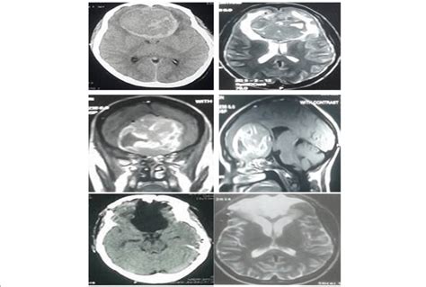 Giant Olfactory Groove Meningioma Upper Left Axial Ct Brain With