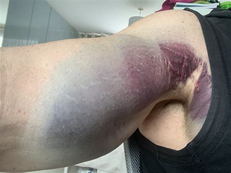 Torn pec best recovery protocol - ExcelMale Forum. TRT, Hormones