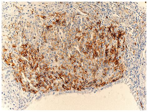 Immunohistochemical Features Of Extensive Sex Cord Like Components A