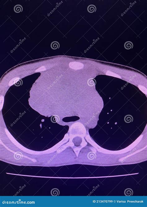 CT Scan Mass at Interior Mediastinum Stock Image - Image of hospital ...