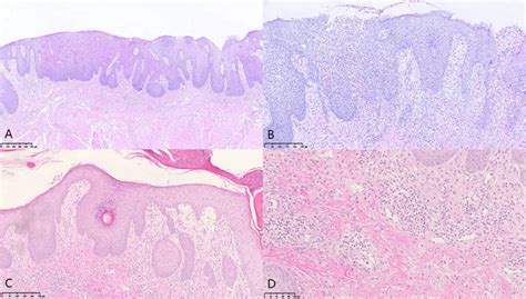 Rare Mucocutaneous Manifestations Of Ulcerative Colitis A Case Report