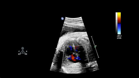 Ecocardiograma Para Qué Es Cardiopatías Congénitas La Paz