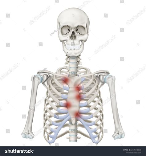 3d Medical Illustration Explain Costochondritis Stock Illustration