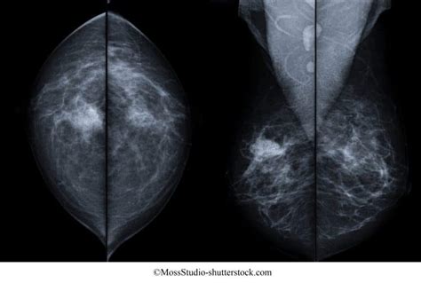 Carcinoma Alla Mammella Sintomi Triplo Negativo Classificazione