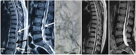 Frontiers Spinal Dural Arteriovenous Fistula A Rare But Treatable