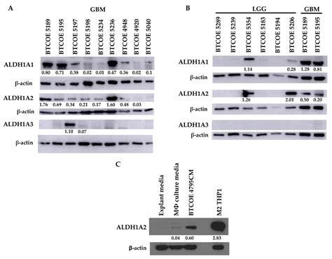 The Presence And Potential Role Of Aldh1a2 In The Glioblastoma