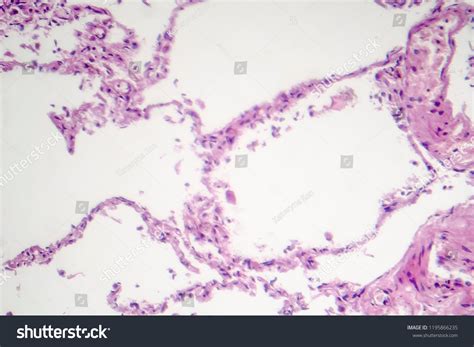 Diffuse Lung Emphysema Light Micrograph Photo Stock Photo