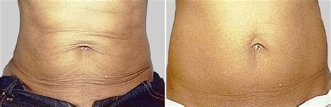 Exilis Nashville Tn