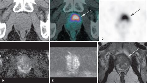 Scielo Brasil Preoperative Evaluation Of Prostate Cancer By 68 Ga