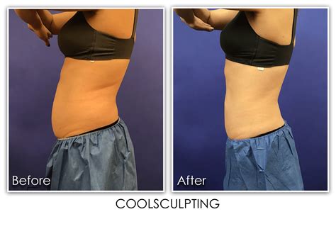 Coolsculpting Pro Archives Skin Rejuvenation Clinic Skin Rejuvenation