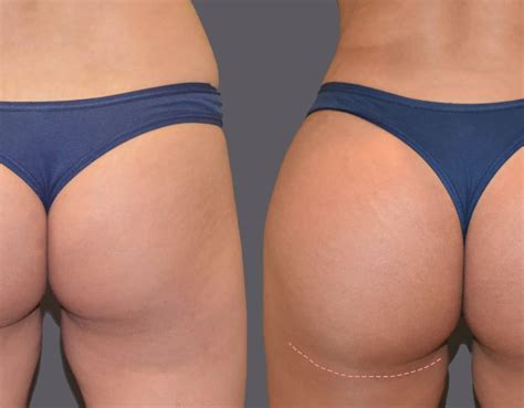 The Difference Between A Brazilian Butt Lift Vs Traditional Butt Lift