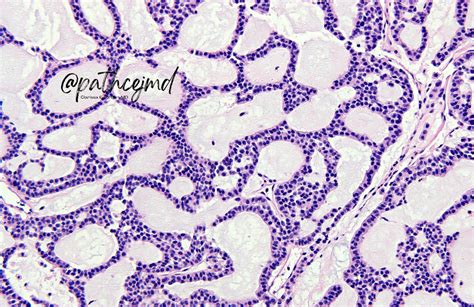 Case 9 Acinic Cell Carcinoma