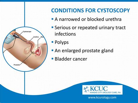 PPT - Cystoscopy - Detect and Treat Symptoms of Bladder Cancer PowerPoint Presentation - ID:7326754