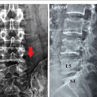 Lumbar Spine Plain Radiographs Anteroposterior And Lateral Views