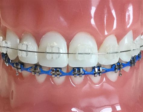 Ceramic Braces Vs Metal Braces Sherman Balhoff Orthodontics