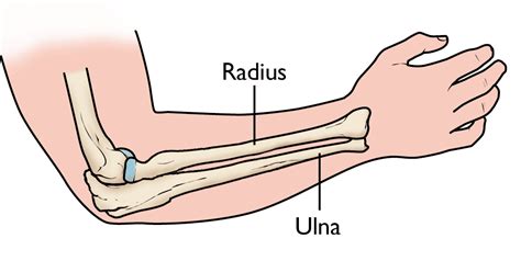 Distal Radius Fractures Broken Wrist Orthoinfo Aaos